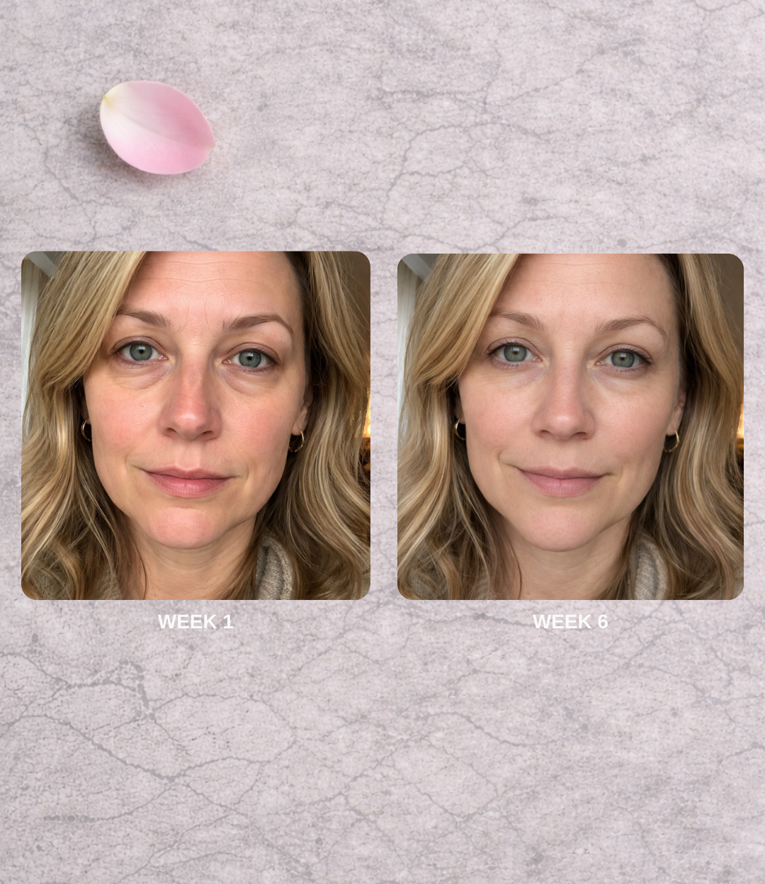 Hue Micro-Needle Patch